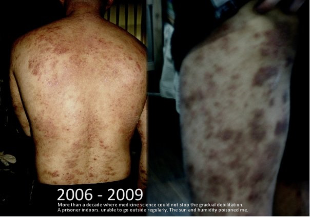 Kenneth Koh Ezcema Severe LetterstoamoderndayJob Job-20151206